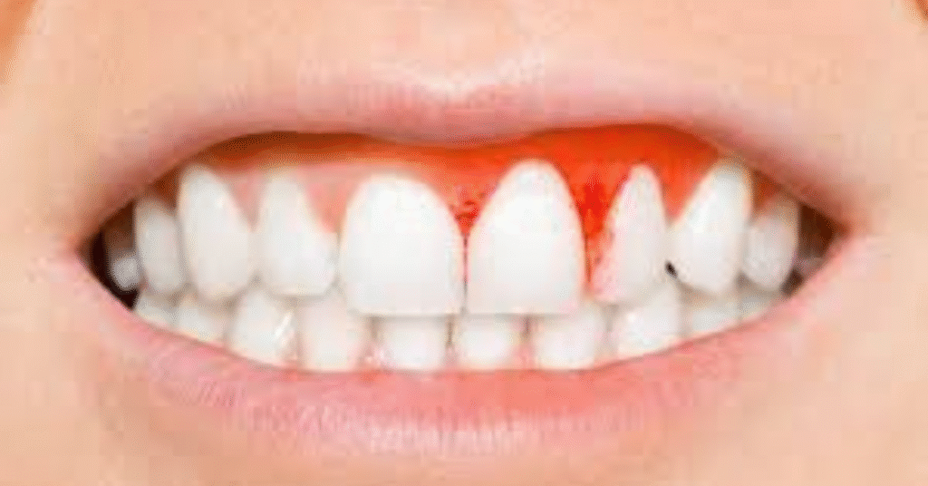 खून आते मसूड़ों का इलाज – घरेलू और प्राकृतिक उपाय