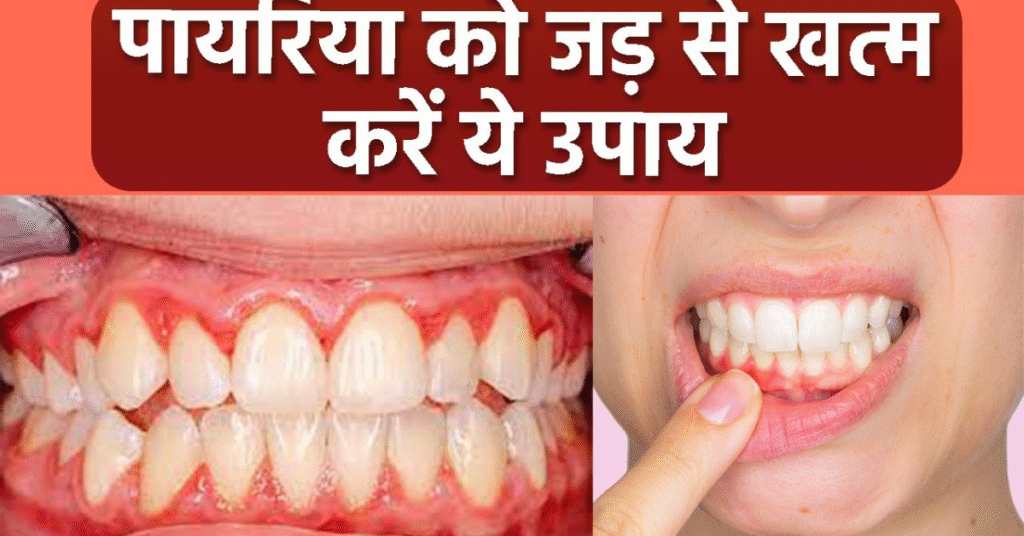 पायरिया का घरेलू इलाज – आयुर्वेदिक और प्राकृतिक उपाय