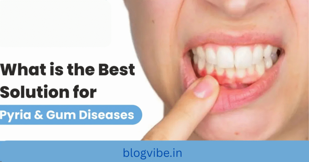 पायरिया के लक्षण, कारण और घरेलू नुस्खे