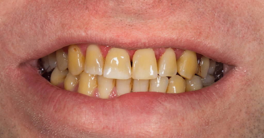 धूम्रपान और दांतों पर इसका प्रभाव: कारण, नुकसान और समाधान